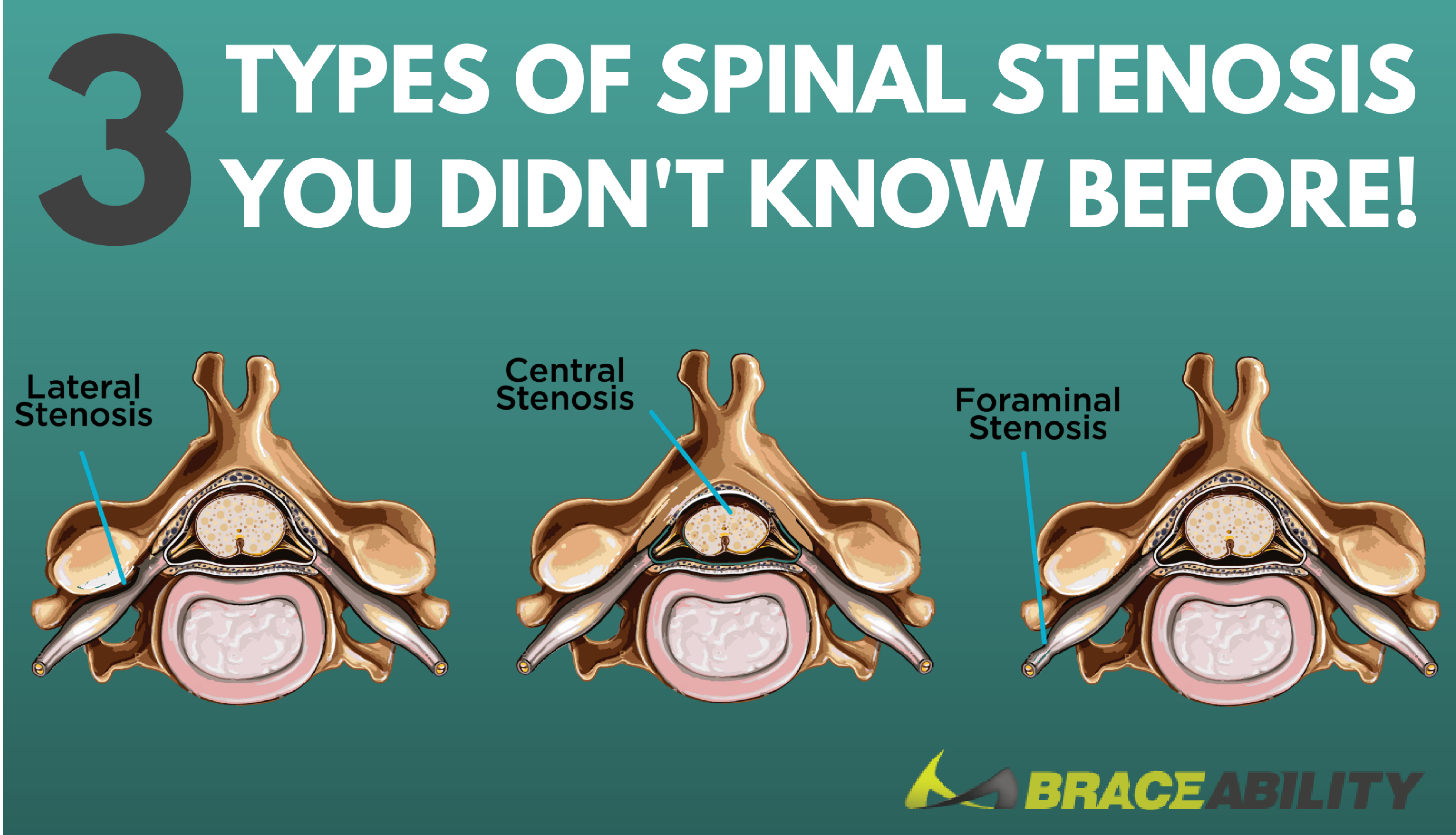 Vertebral Canal Vs Vertebral Foramen Vertebral canal vs vertebral foramen