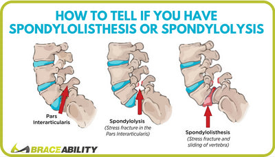 How to Tell If You Have Lumbar Spondylolisthesis or Spondylolysis in Your Lower Back