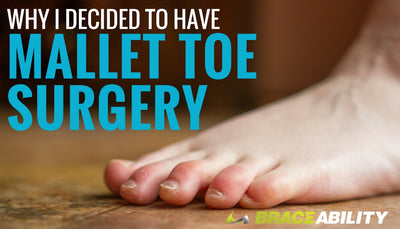 Why I Decided to Have Mallet Toe Surgery