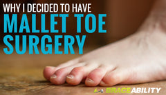 Why I Decided to Have Mallet Toe Surgery