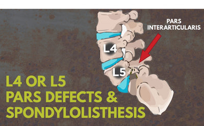 Have an L4-L5 Pars Defect in Your Spine? It Might be Spondylolisthesis