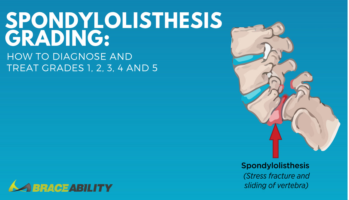 Which Grade of Spondylolisthesis Do I Have? 1, 2, 3, 4, or 5