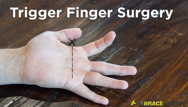 There Are Two Surgical Options to Treat Trigger Finger Pain