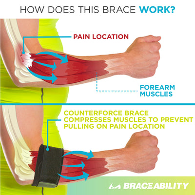 the counterforce tennis elbow brace works to compress the muscle that causes tennis elbow pain