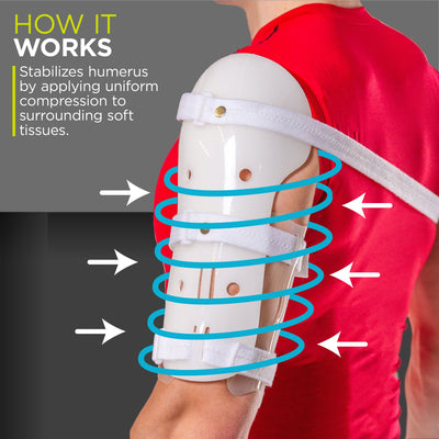 A Sarmiento Humerus Fracture Brace compresses the muscle around the broken arm acting as a splint