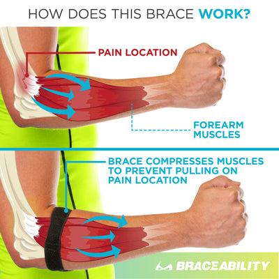 The braceability elbow tendonitis treatment brace applies pressure to the epicondyle to reduce epicondylitis pain